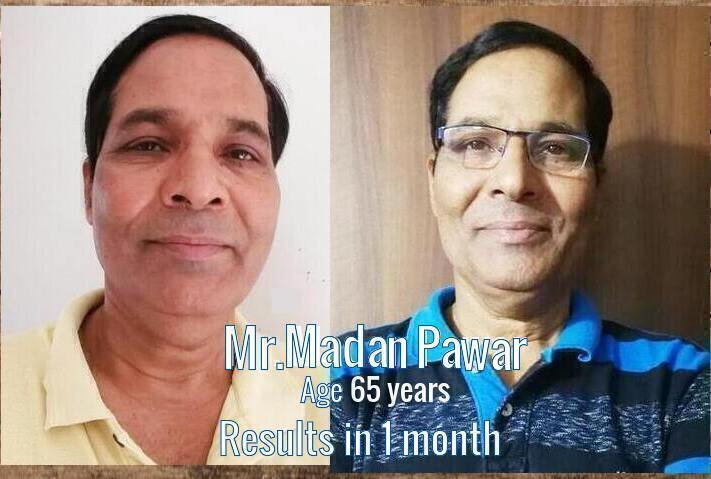 madan pawar facial exer pre post