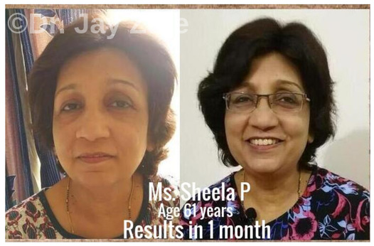 sheela pre post facial exercise watermark